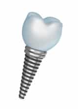 dental implants - Spring Valley